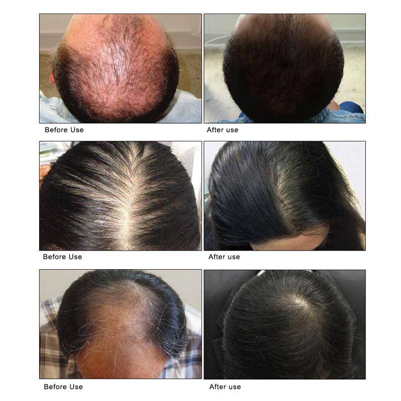 ARTISCARE Hair Growth Essence Spray 30mL Anti Hair Loss Nourish Roots Hair Care
