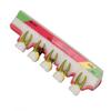 Teeth Periodontal Disease Model Different Stages Resin Dental Periodontitis Display Model