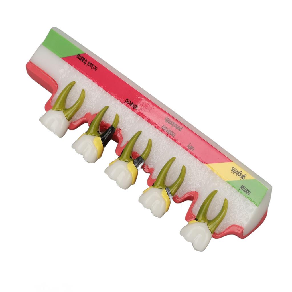 Teeth Periodontal Disease Model Different Stages Resin Dental Periodontitis Display Model