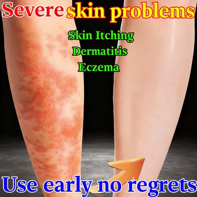 Gentle Herbal Dermatitis Cream - Calms Itching Eases Eczema Safe for Sensitive Skin Types