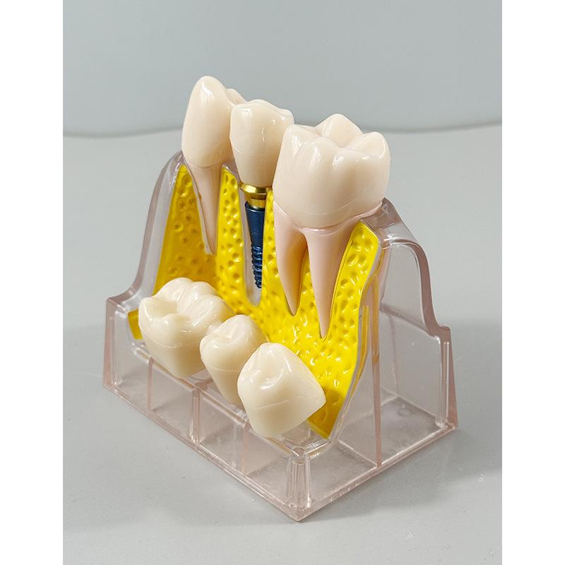 Прозора Знімна Повна Модель Щелепи з М'якими Яснами та Зубами для Підготовки до Імплантації