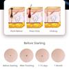 177---50/100pcs surgery sterile needle small mole removal pen needle mole freckles and other machine accessories