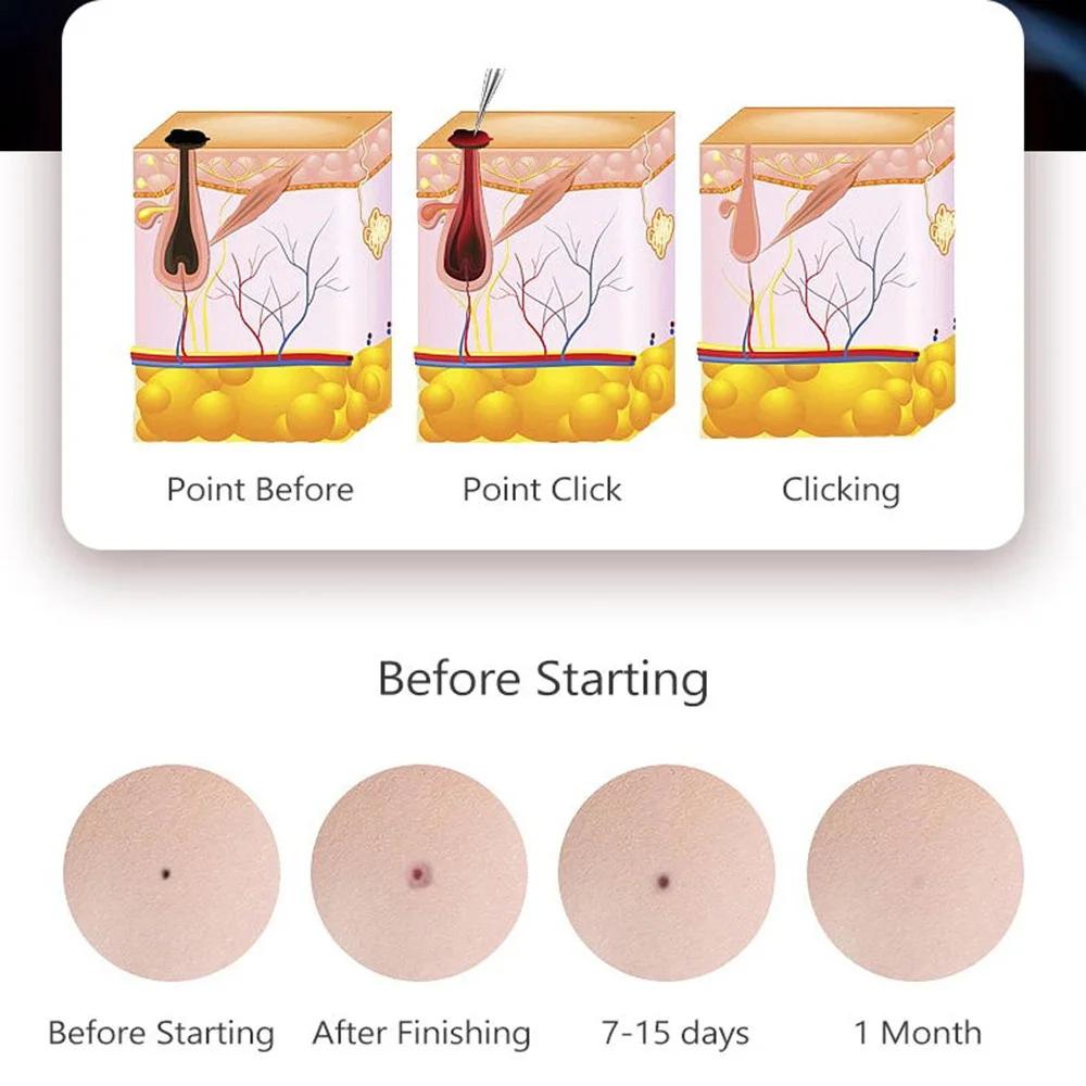 177---50/100pcs surgery sterile needle small mole removal pen needle mole freckles and other machine accessories
