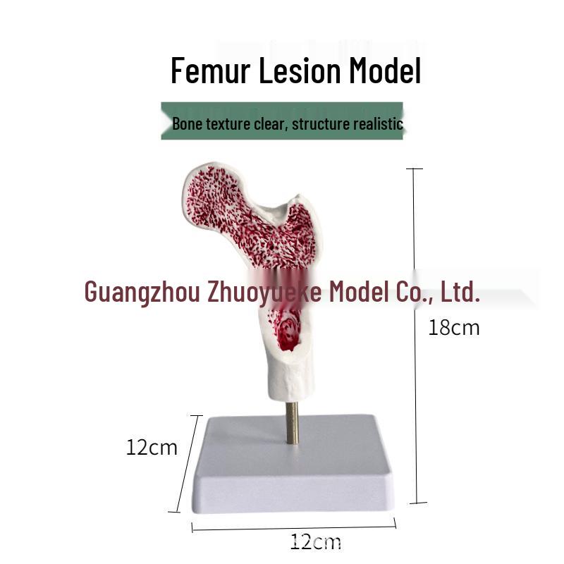 Osteoporosis Leg & Spinal Column Model: Human Femur, Lumbar Vertebrae, Pathological Cross-Section