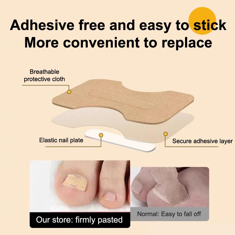 Ingrown Toenail Toe Correction Stickers Paronychia Treatment Recover Corrector Patches Feet Care Paronychia Treatment Recover