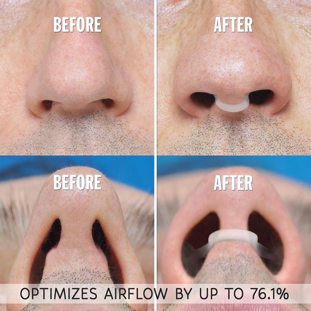 1~4Pcs Silicone Nose Clip Anti Snoring Nasal Dilator Stop Snore Aid Easy Breathe Improve Sleeping Rhinitis