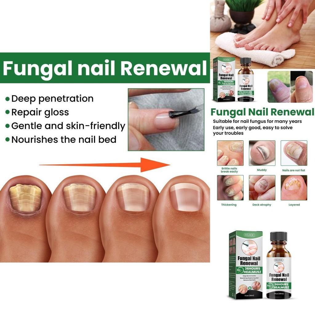 Eelhoe Nail Care Solution For Fungal Toenail Treatment With Nourishing Moisture
