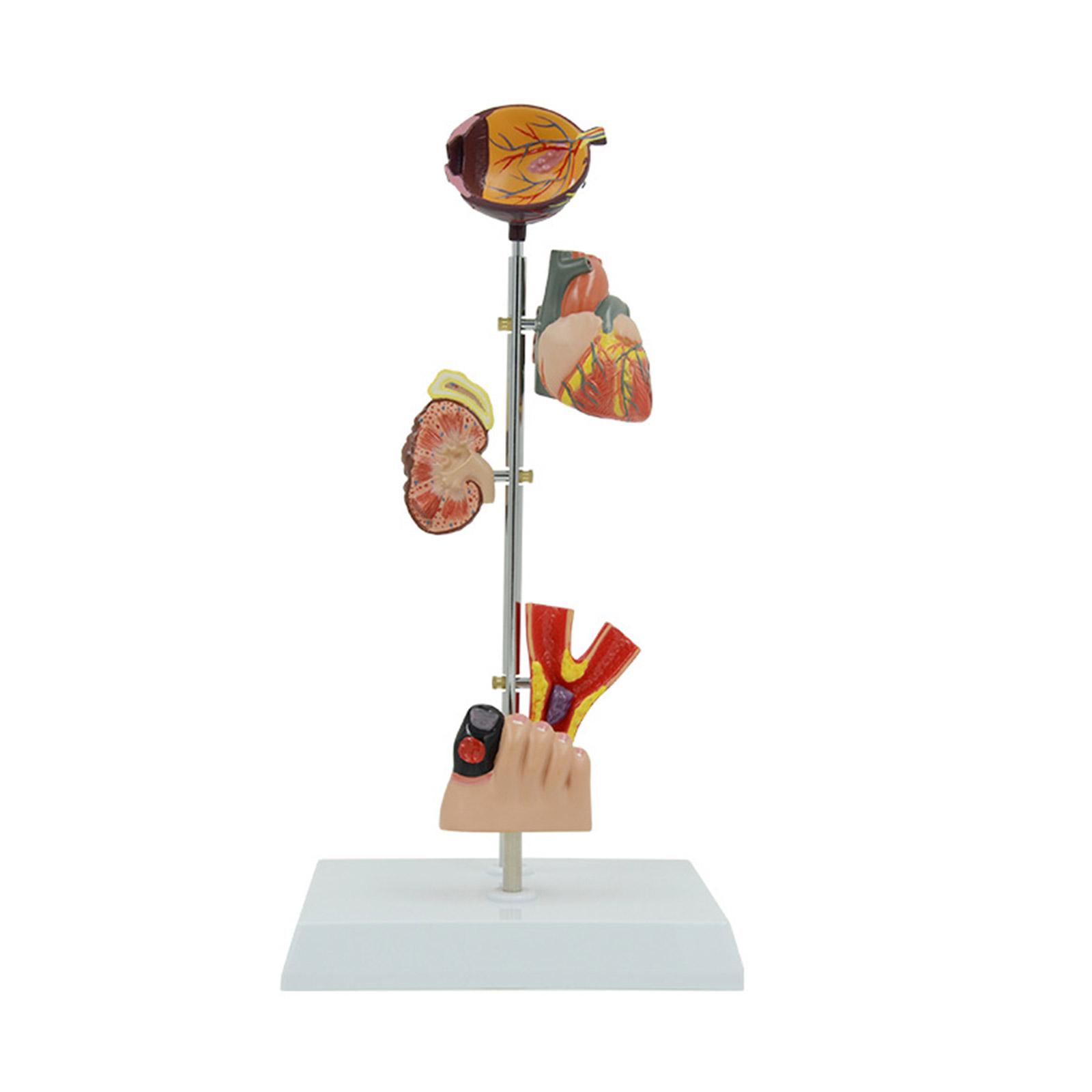 Diabetes Pathology Demonstration Human Organ Anatomy Model 1