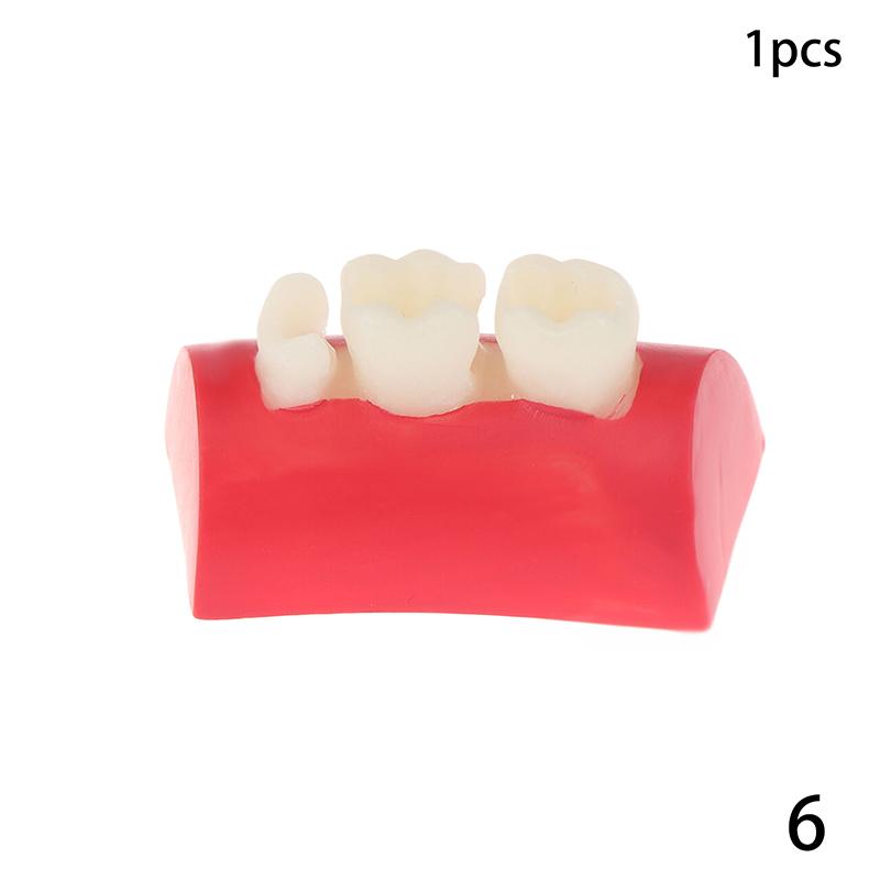 Dental Inlay Exercise Model Block Filling Exercise Plaster/Resin Materials Oral Filling Model For Dentistry Teaching Study