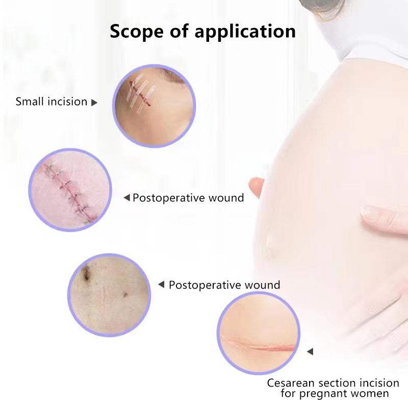 5Sheets 12*100Mm Wound Closure Tape Adhesive Sterile Medical Bandage Strip Skin Repair First Aid Surgical Breathable Tape