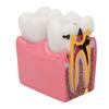 Dental Caries Model Tooth 6X Decay Demonstration Model for Teaching Study Laboratories