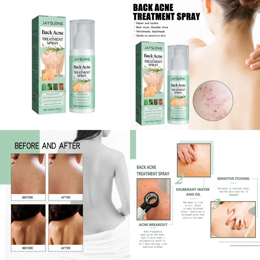 Jaysuing Back Acne Repair Spray For Effective Blemish Treatment And Skin Smoothing