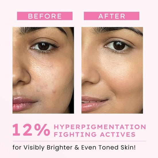 Hyphen Advanced De-Pigmentation Serum For Hyperpigmentation, Melasma, Dark Spots & Scars With 2% Kojic Acid | Visibly Brightens- 30ml