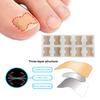Yousheng 20Pcs Ingrown Toenails Correction Patches Breathable Painless Ingrown Toenail Treatment Tool Professional Ingrown Toenail Straightener