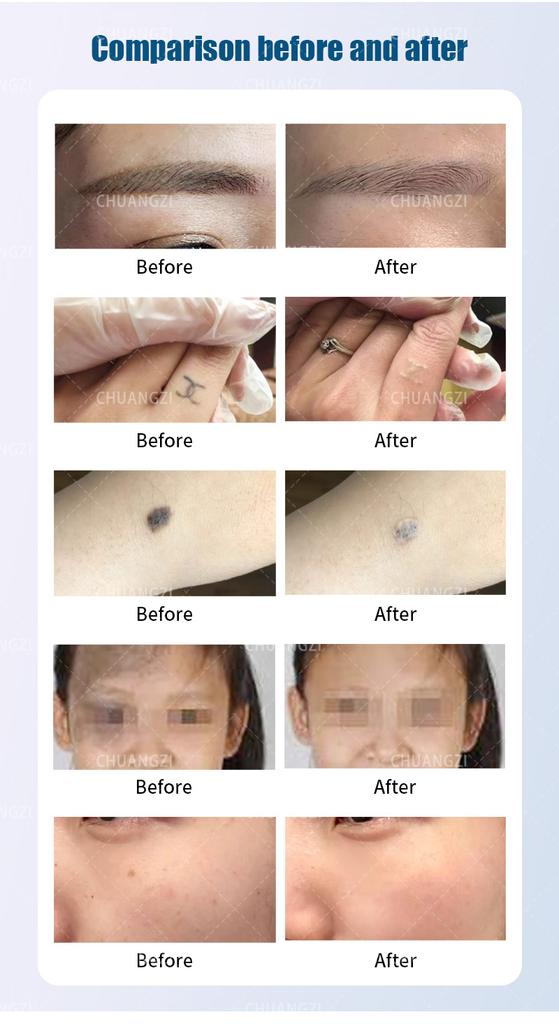 Best Sellers Laser Beauty Machine Portable Q-switch ND YAG Laser Tattoo Removal Pigmentation Removal Carbon Peeling Machine