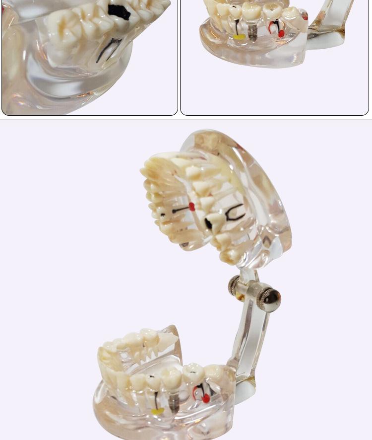 Human Tooth Anatomy Model for Teaching and Simulation - Detachable Denture Mold