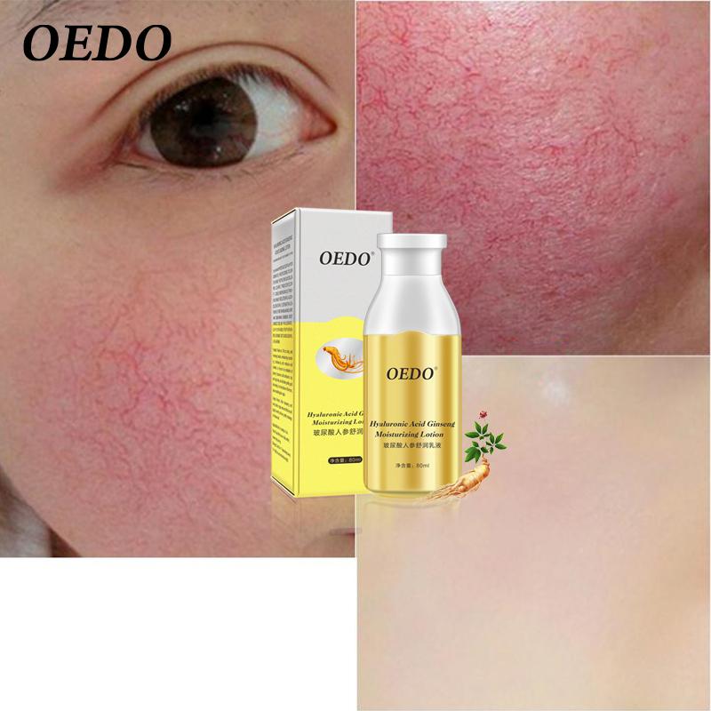 OEDO Hyaluronsäure Ginseng Feuchtigkeitsspendende Lotion Hautpflege Aufhellung Akne Behandlung Tiefe Haut Reparatur Gesichtspflege Öl-kontrollierende Wirkung