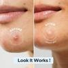 Large Pimple Patches Bulk For Face Hydrocolloid Multi-Shape Invisible Removal Acne Patches Covering Body Forehead Chin Blemishes