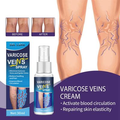 30ML Varicose Vein Massage Spray Relieve Leg Discomfort Improve Circulation Gentle Effective Varicose Spray