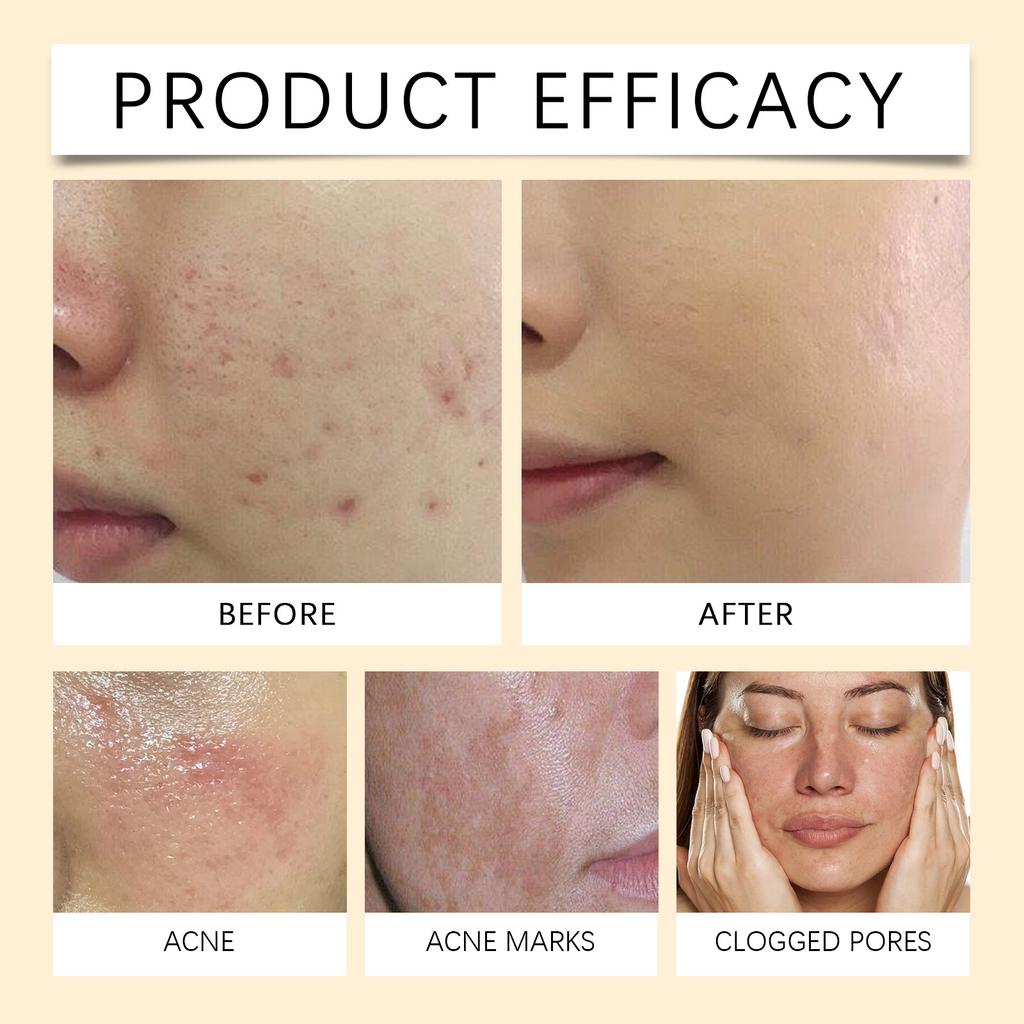 Acne Soothing Cream Gently Cleanses And Smoothes The Skin Hydrates The Skin Anti-aging Firming Gentle Skin Care Moisturizing Hydrating Skin Care