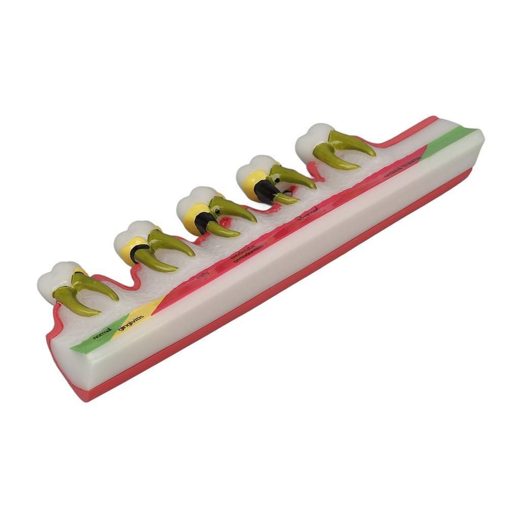 Teeth Periodontal Disease Model Different Stages Resin Dental Periodontitis Display Model