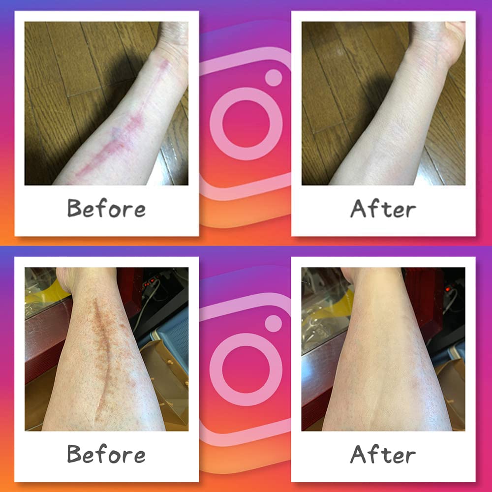 Foundation Tape To Hide Skin Scars and Large Same 5 Hides Wrist Made In Japan (tape Self-harming Marks) Size, Color, Sheets, Cuts, Waterproof, (beige