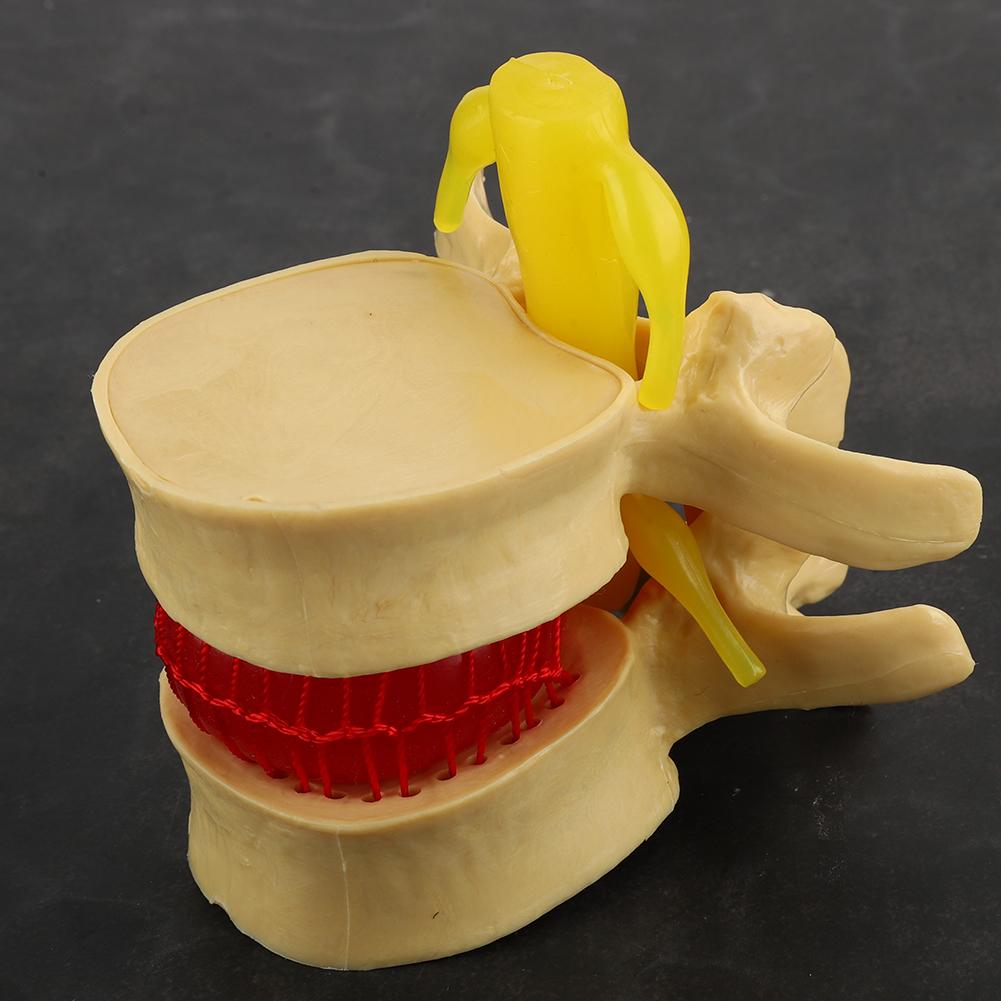 1:1.5 Lumbar Disc Herniation Demonstration Model Study Learn Human Spine