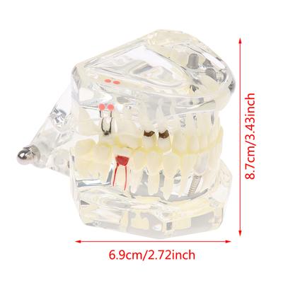 Výuka můstku pro obnovu zubního modelu zubního implantátu pro studium zubní vědy