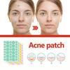 Eelhoe Colorful Acne Patches Gentle Non-irritating Hydrocolloid Treatment For Blemishes And Pimples 144pcs