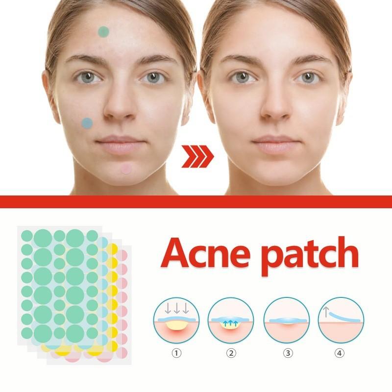 Eelhoe Colorful Acne Patches Gentle Non-irritating Hydrocolloid Treatment For Blemishes And Pimples 144pcs