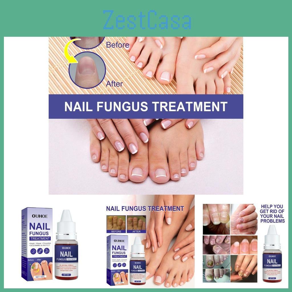 Ouhoe Nail Repair Solution Thickening Treatment For Ingrown Nails And Fungal Issues