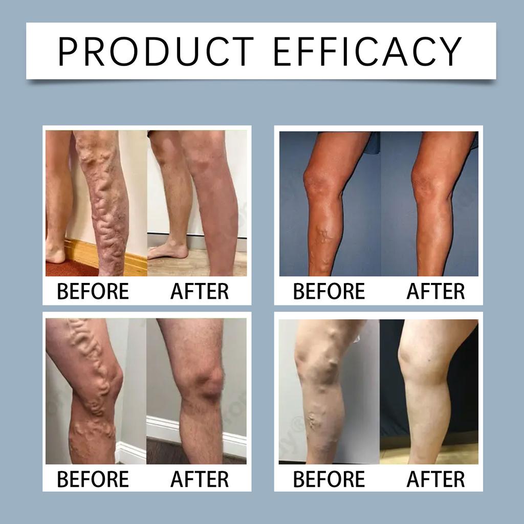 Plaster na nogi z mikroigiełkami; Łatka na żylaki; Łatka na nogi