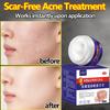Acne-Clearing Cream-Natural Extraction+Pore-Shrinking+Blackhead-Removing,Acne-Prone Skin Daily Care & Post-Acne Pore/Blackhead Improvement