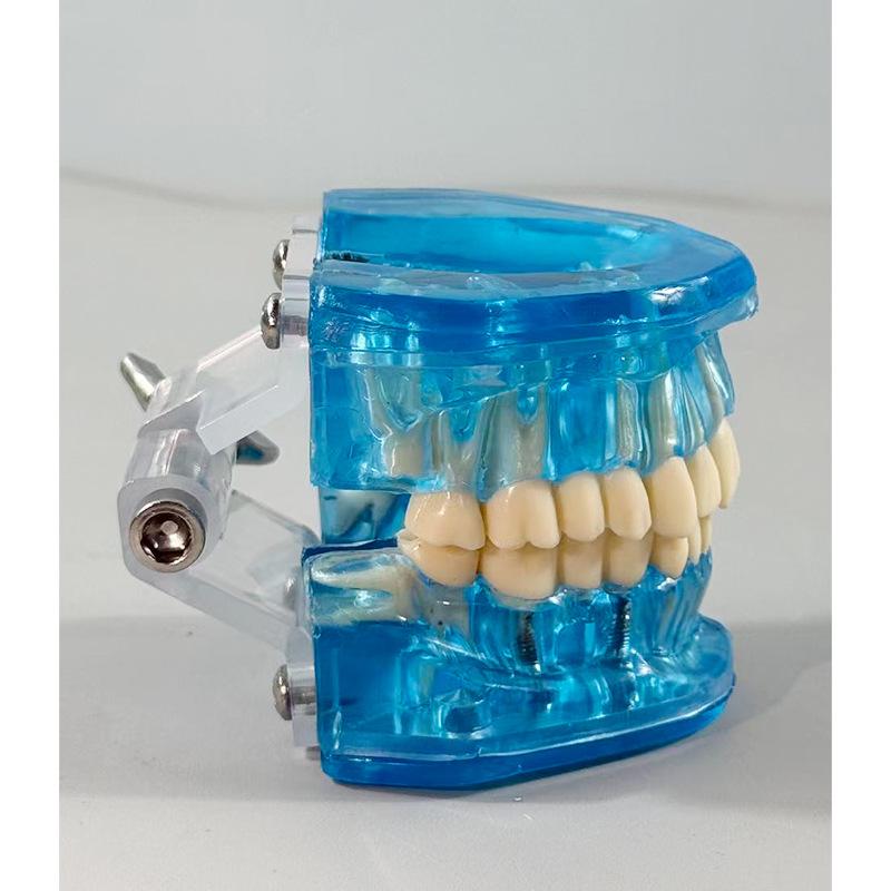 Прозора Знімна Повна Модель Щелепи з М'якими Яснами та Зубами для Підготовки до Імплантації