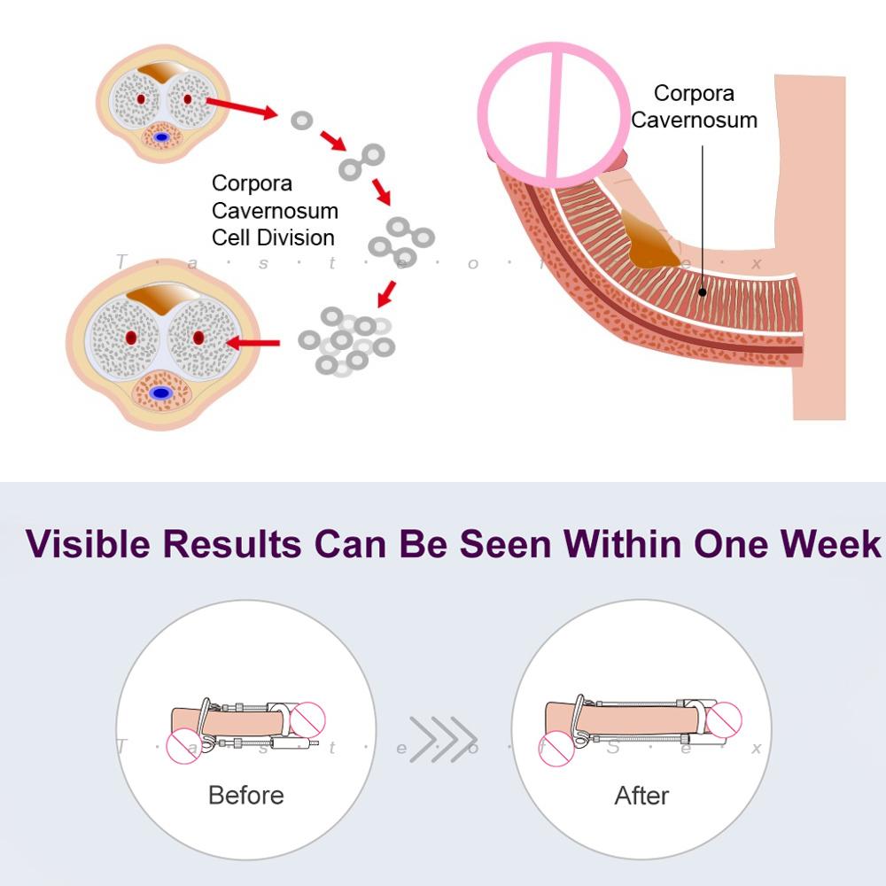 Zubehör für Penisvergrößerer und -extender der 3. Generation für die Edge Tension-Penispumpe, Ersatzstangen-Schraubenriemen für den Stretcher Enhancer