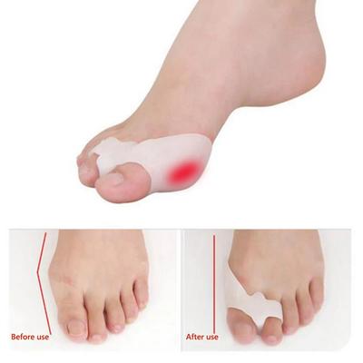 Silikon-Gel-Fußzehen, Zwei-Loch-Zehentrenner, Daumen-Valgus-Schutz, Ballen, Hallux-Valgus-Schutz, Füße, überlappende Polstereinlage, 2 Stück
