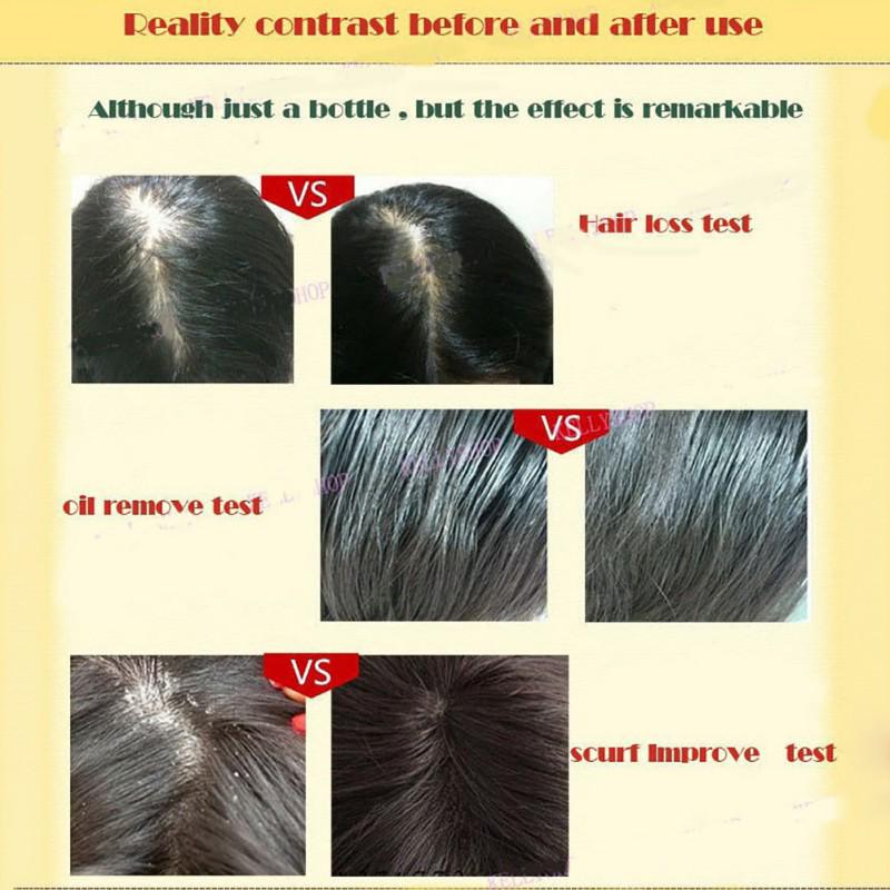 Essence de croissance des cheveux, guérison naturelle de la perte de cheveux, croissance plus rapide, huile essentielle
