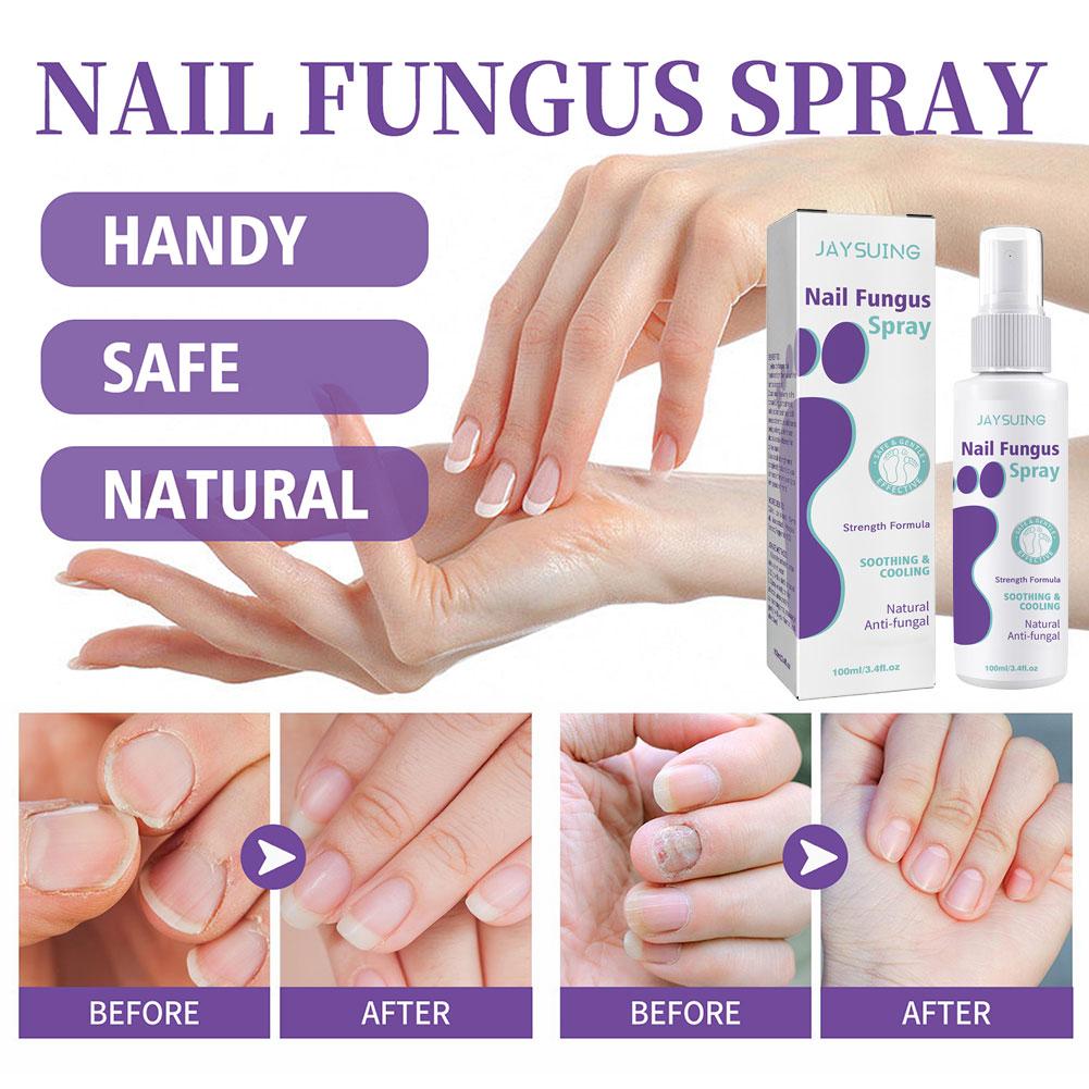 1/3/5PCS Nail Fungus Spray Reduce Beriberi Deodorize Remove Onychomycosis Paronychia Deeply Mild Cleansing Nail Care Spray