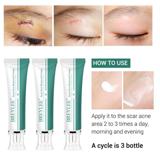 Breylee Acne Scar Removal Cream Stretch Marks Treatment Repairing Skin Care