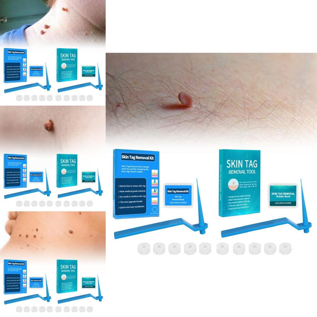 Effective Skin Tag Removal Tag Refill Band Set With 10 Pieces For Smooth Skin