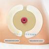10Pcs Barrier Stoma Ostomy Strips Tape Strip Rings Adhesive Pressure Fixing Colostomy Leak Proof Colostomy Bag Barrier Strip