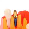 Dental 4 Times Implant Teeth Model Analysis Crown Bridge Demonstration Removable Model Dentistry Study Training Teaching Model