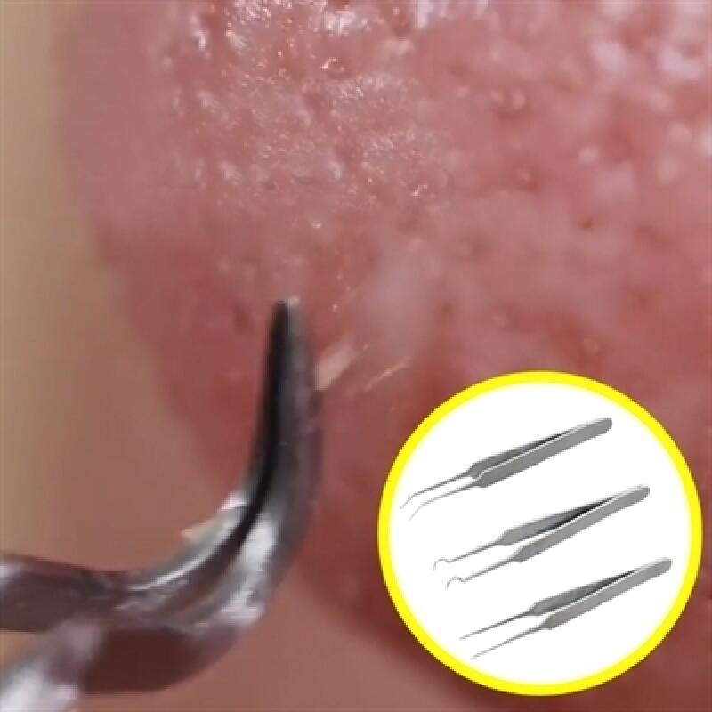 3 types of sebum removal extrusion tweezers