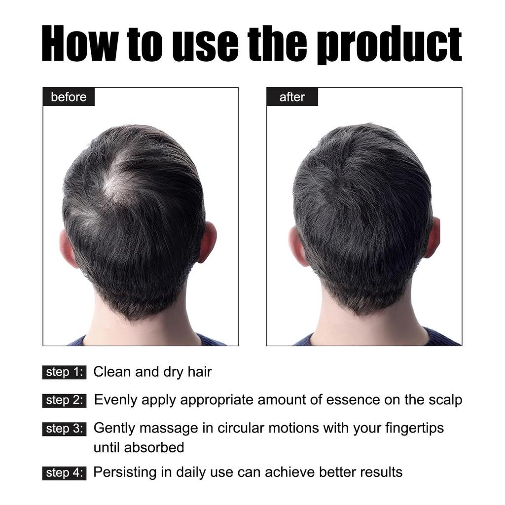 East Moon Haarwachstumsserum für Männer 30ml - Gegen Haarausfall, Stärkt das Haar, Fördert das Haarwachstum, Feuchtigkeitsspendende Haarkur