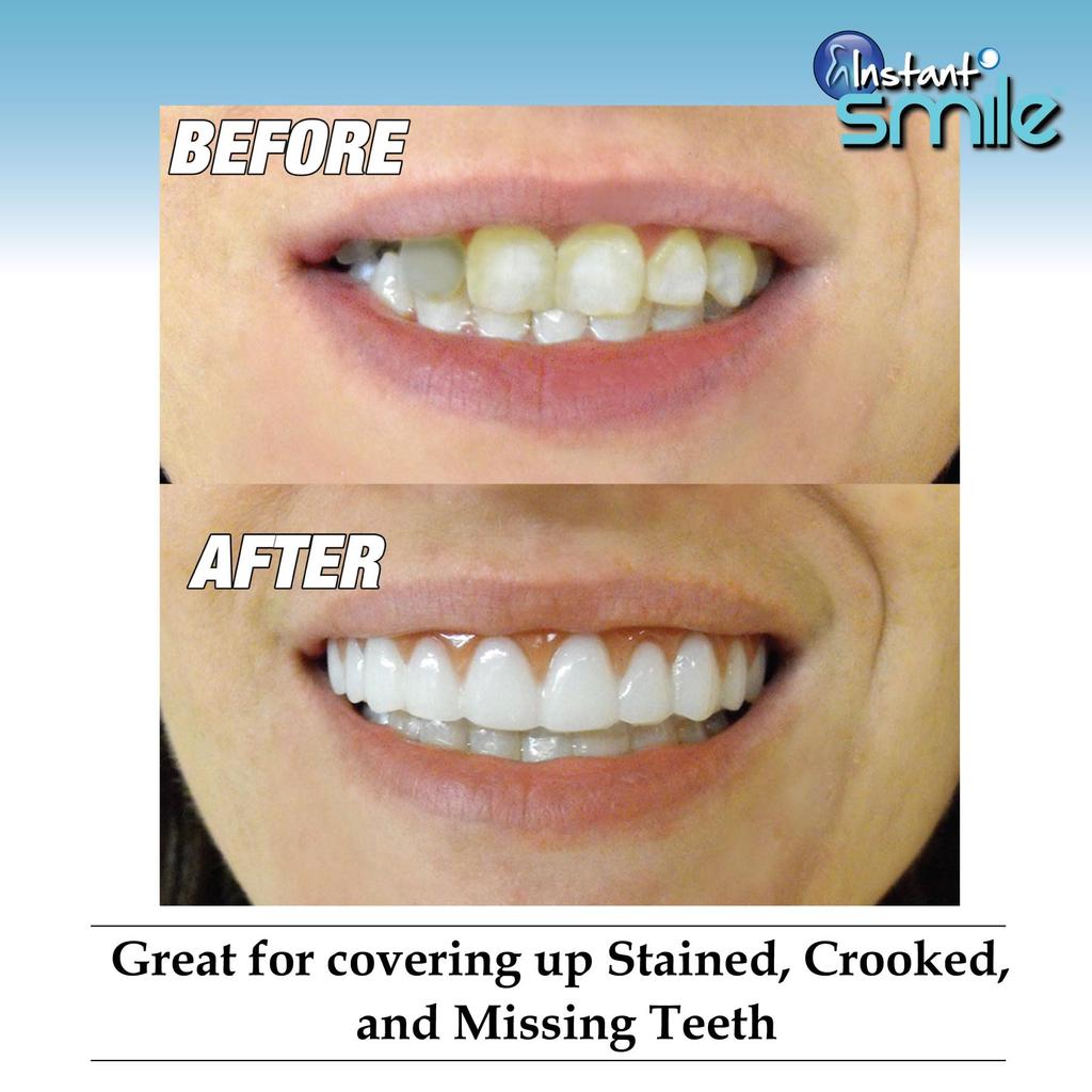 Instant Smile Teeth Comfort Fit