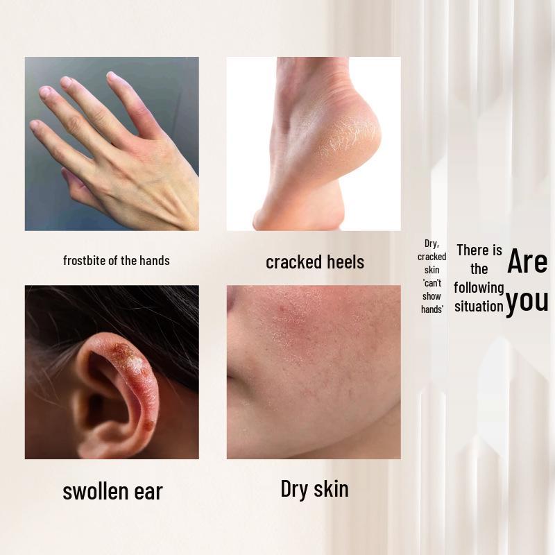 Badger Moisturizing Hand & Foot Cream: Anti-Freeze, Anti-Itch, Dry Crack Relief for Heels and Hands. Standard Size