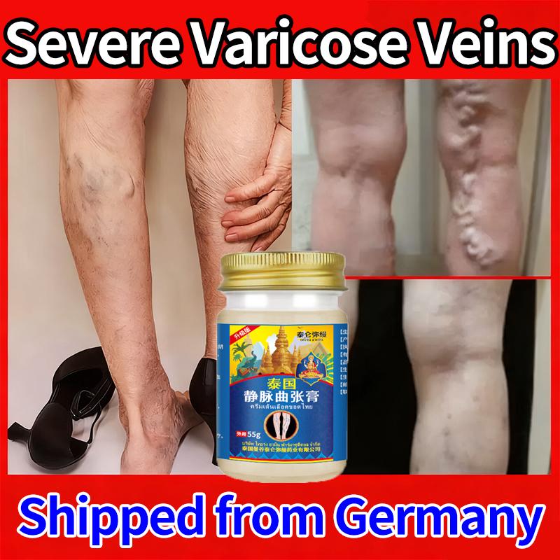 Therapy for Relieving Varicose Vein Symptoms