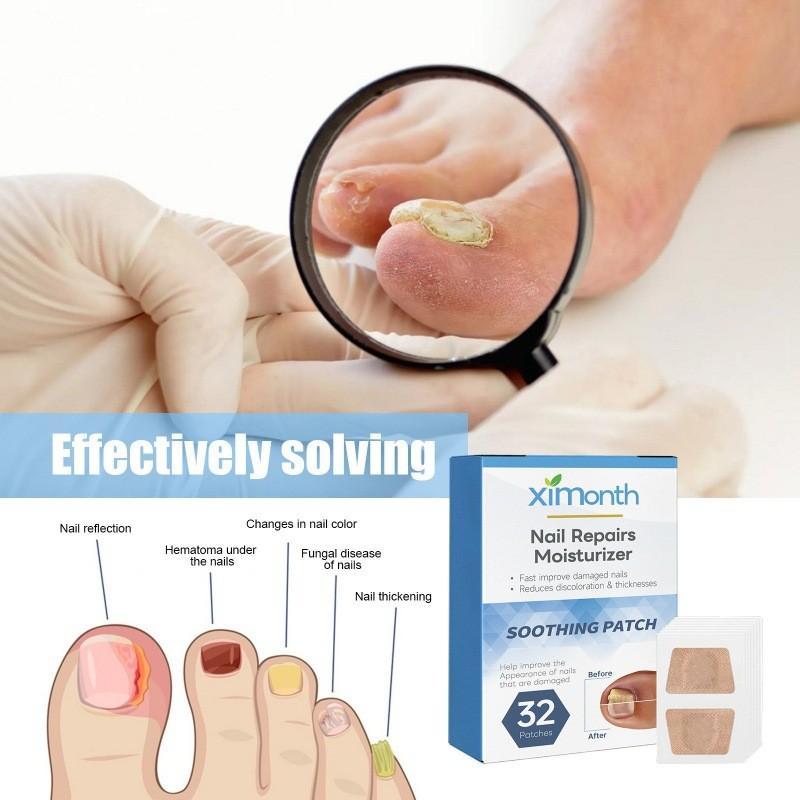 Ximonth Nagelreparatur-Pflaster Weiches Gel Verdickende Nagelpflege Zur Behandlung von Pilzinfektionen