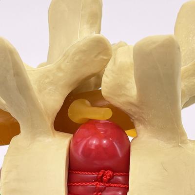 Profession Lumbar Model Human Anatomy Skeleton Spine Lumbar Disc Herniation Teaching Model Demonstration Model Teaching Model