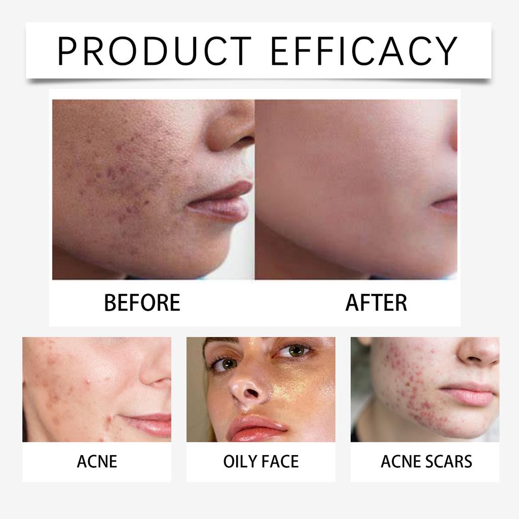 Acne Removal Ointment For Men And Women To Acne Marks And Acne Pits